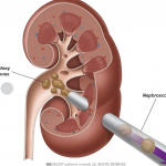 Kidney Hospital